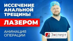 Иссечение анальной трещины лазером