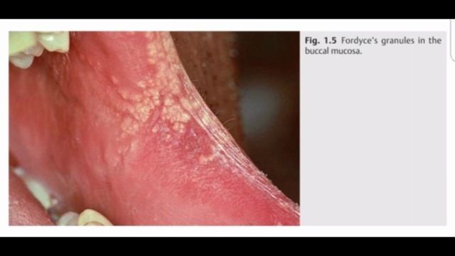Fordyce's Granules. #anatomy #oral anatomy смотреть онлайн