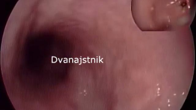Endoskopski pregled zgornjih prebavil смотреть онлайн