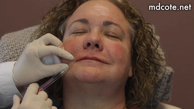 Lip Filler on Thin, Older Lips | 1 Syringe of Juvederm and Volbella смотреть онлайн