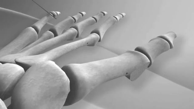 Hallux Valgus Repair with Arthrex® Mini TightRope® смотреть онлайн