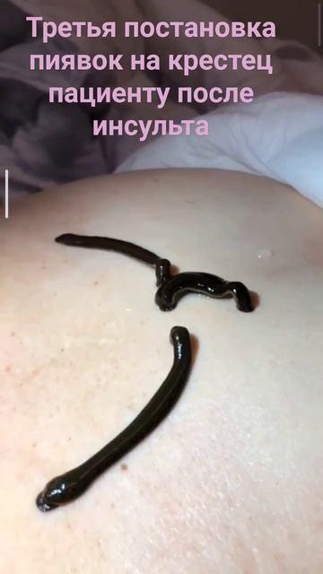 Встаём на ноги после инсульта. Часть 6. Пиявки на крестец смотреть онлайн