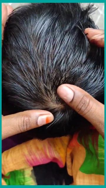 #shorts#nits&lice picking from my sons's hair смотреть онлайн