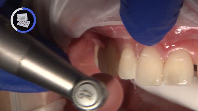Selective COSMETIC Enameloplasty in the ANTERIOR Teeth смотреть онлайн
