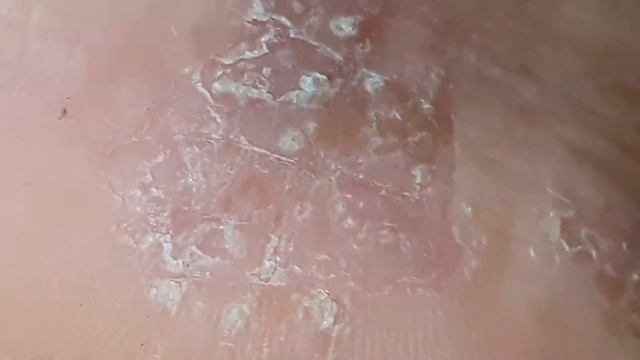 Tinea Pedis 10years girl смотреть онлайн