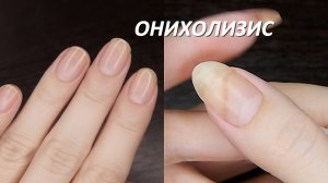 Онихолизис мой опыт, травматический онихолизис