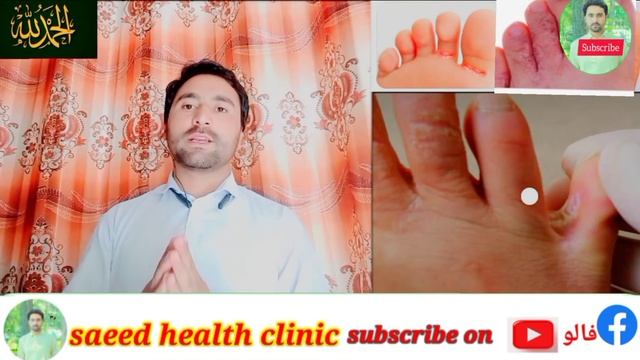 tinea pedis treatment@Saeedanwar745#antibiotics #tinea#medical смотреть онлайн