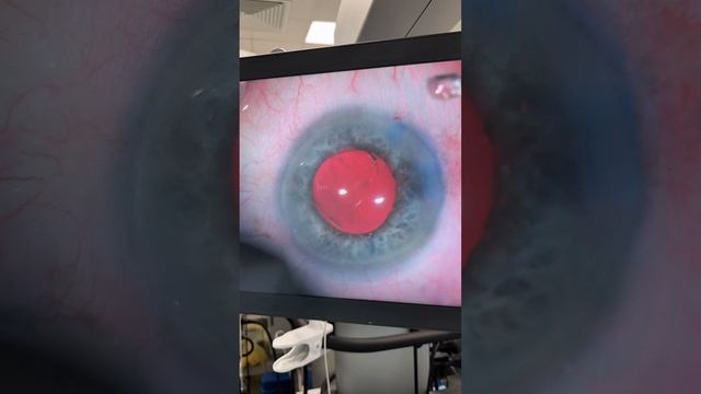 Зрелая катаракта глаза. Лечение. Нужно ли ждать пока катаракта "созреет"? смотреть онлайн