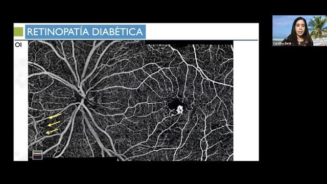 FLUORANGIOGRAFIA VS ANGIO OCT смотреть онлайн