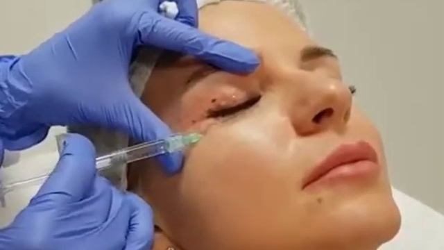 Мезотерапия зоны глаз