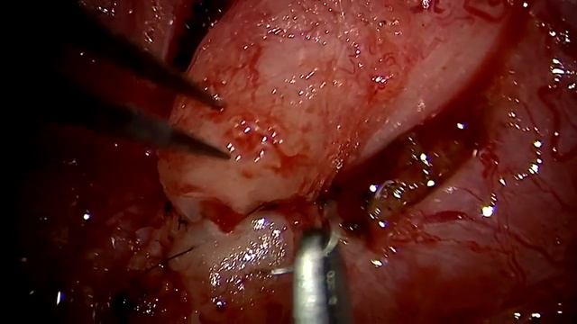 Vasectomy reversal microsurgery - Dr. Kovac - Feb 10 2019 - HD смотреть онлайн