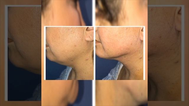 CHIN LIPO NECK LIPO BY DR. THOMAS BARNES, NEWPORT BEACH COSMETIC SURGEON! MUST SEE THIS!