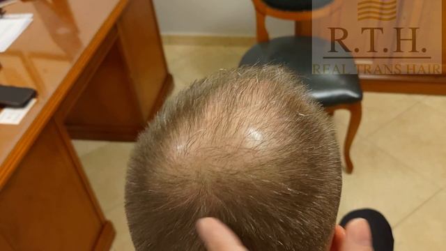 Возможно ли при 5 стадии облысения вернуть красивую прическу? смотреть онлайн