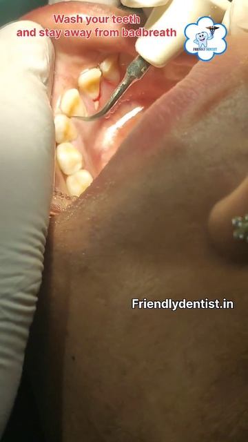 full mouth ultra Sonic scaling DrDebabrata Sahu Friendlydentist appointment whatapp -7978535536 смотреть онлайн