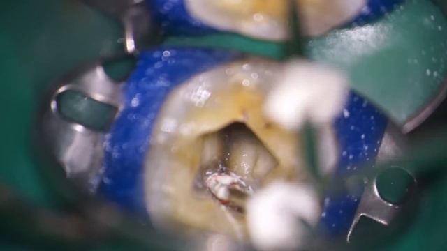 Root Canal Filling With Bioceramic Sealer