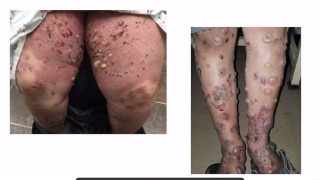 2 MINUTES DERMATOLOGY : BULLOUS PEMPHIGOID