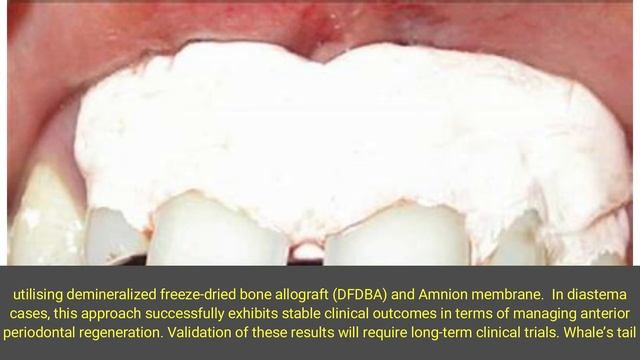 Case Report on Modified Whale’s Tail Technique Using Amnion Membrane for Periodontal Regeneration смотреть онлайн