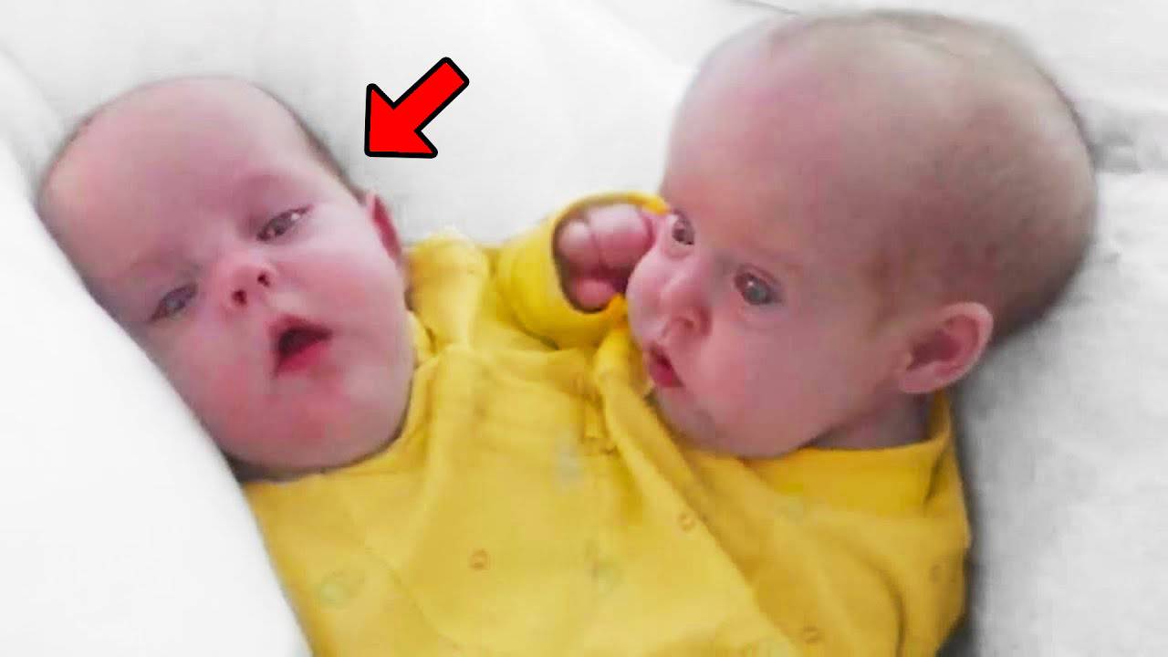 Помните этих сиамских близнецов, разлученных 18 лет назад? Вот что с ними случилось! смотреть онлайн