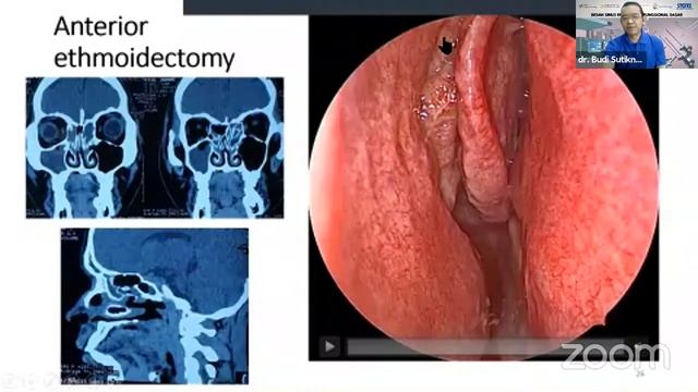 003 AMC Webinar Anterior Ethmoidectomy 190920 смотреть онлайн