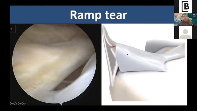 Advanced Arthroscopy -"Master class on ROOT & RAMP" | BIOTEK Live Webinar смотреть онлайн