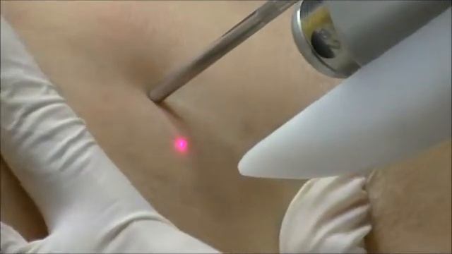 Laserowe zamykanie naczynek смотреть онлайн