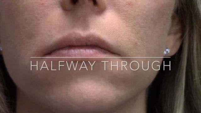 Dermal Fillers for Lip Volume loss смотреть онлайн