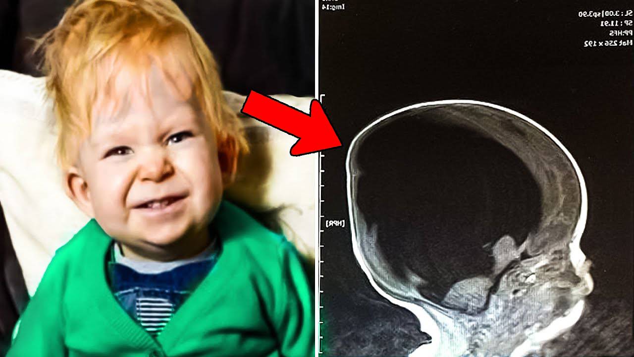 Помните мальчика без мозга? Вот как выглядит его жизнь спустя 9 лет! смотреть онлайн