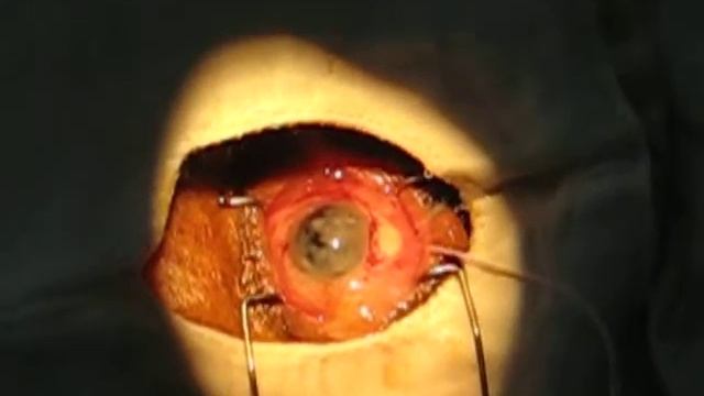 intra ocular lens implantation operation 1 смотреть онлайн