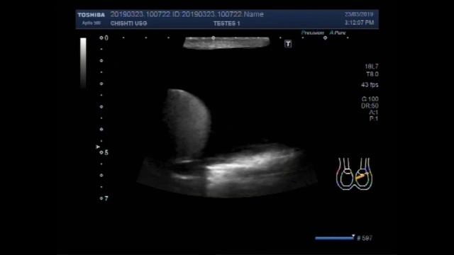 Ultrasound Video showing bilateral scrotal hydrocele. смотреть онлайн