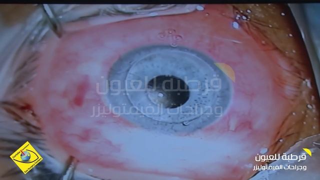 Corneal transplant, intraocular lens , and artificial Iris Implant смотреть онлайн