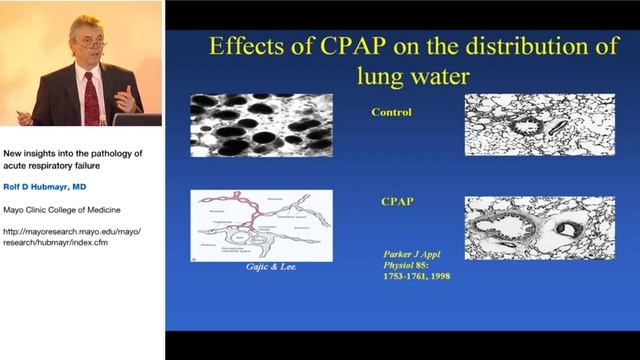 New in pathology of acute respiratory failure Rolf D Hubmayr 2005 Strasb