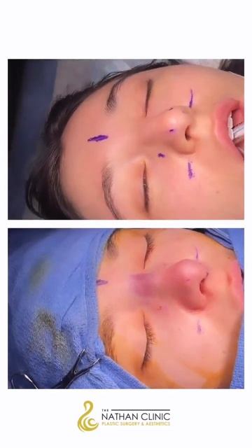 An incredible, natural rhinoplasty result for this patient смотреть онлайн