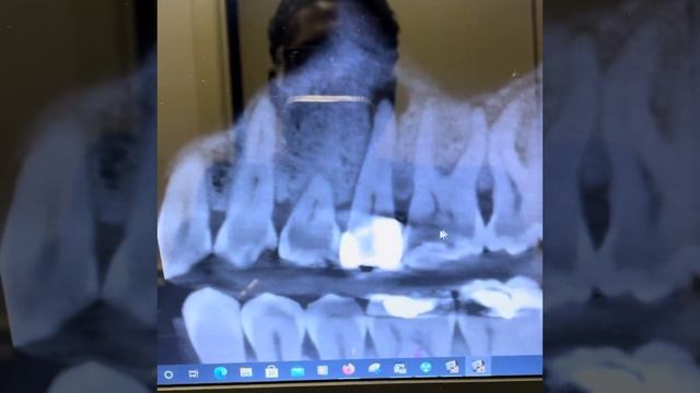 Endodontic Treatment With CBCT And Bioceramic Technology