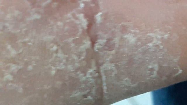 Tinea Pedis смотреть онлайн