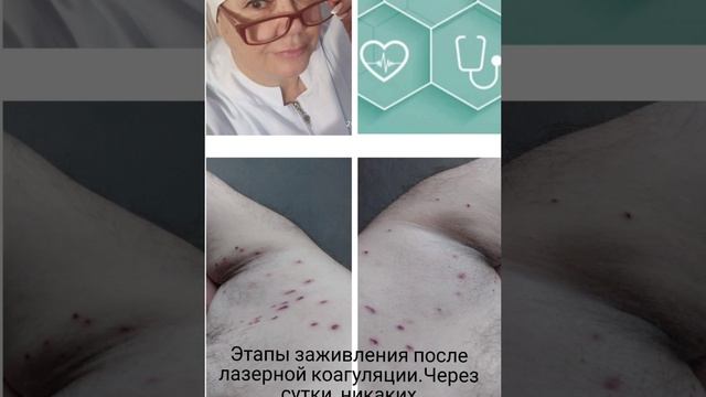#удалениепапиллом#бачатский смотреть онлайн