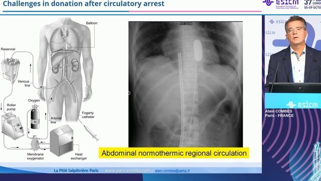 Challenges in donation after circulatory arrest Alain Combes ESICM 2024