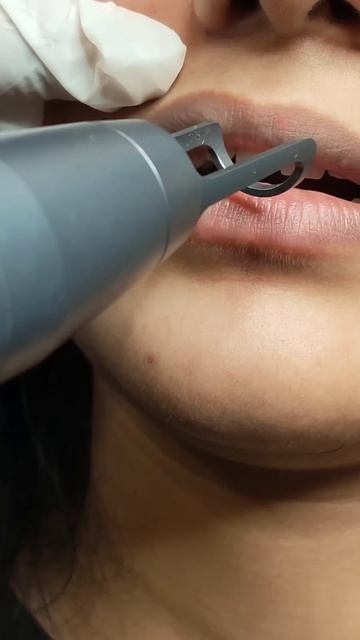 laser toning for lip pigmentation #shorts #darklips смотреть онлайн