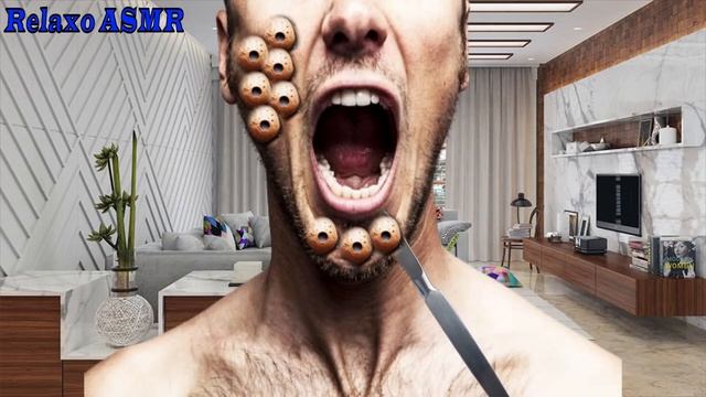ASMR | HEAVY INFECTED  ASMR TREATMENT | REMOVE TRYPOPHOBIA ANIMATION  @relaxoasmrofficial