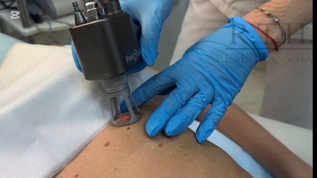 Удаление новообразований! смотреть онлайн