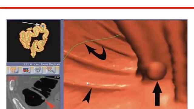 Colorectal Cancer (CRC) Screening смотреть онлайн