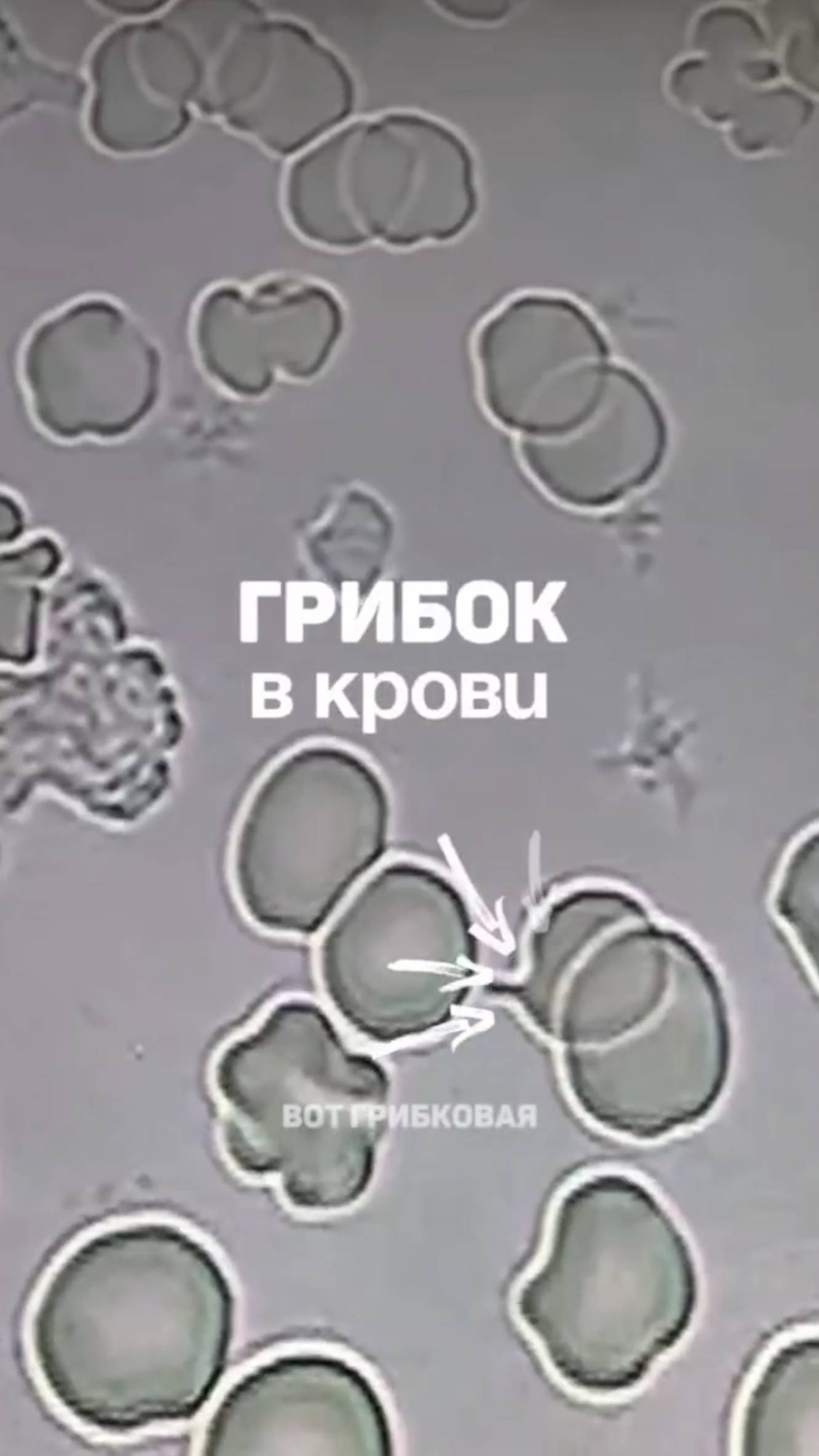 Грибок в крови. Кандида, грибковая инфекция в крови. Съёмка под микроскопом смотреть онлайн