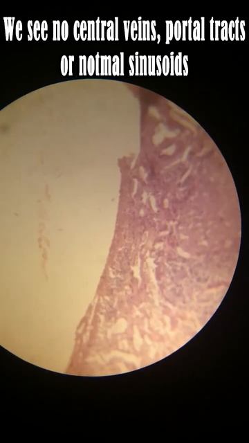 Liver Cirrhosis Histopathology "H&E" смотреть онлайн