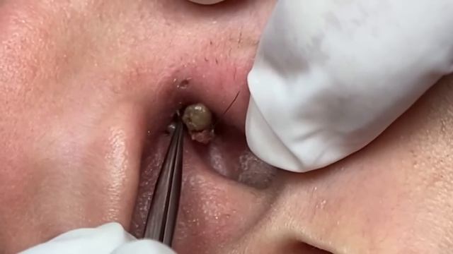 Extreme blackhead extraction! A huge one! смотреть онлайн