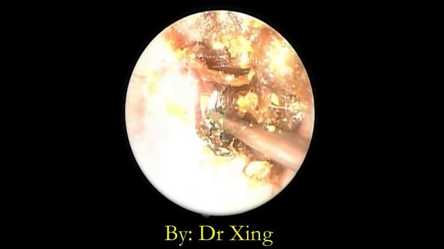 Dr Xing - Cholesteatoma Treatment