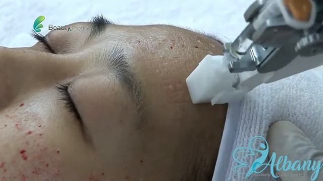 PRP and Plasma injection meso injector смотреть онлайн