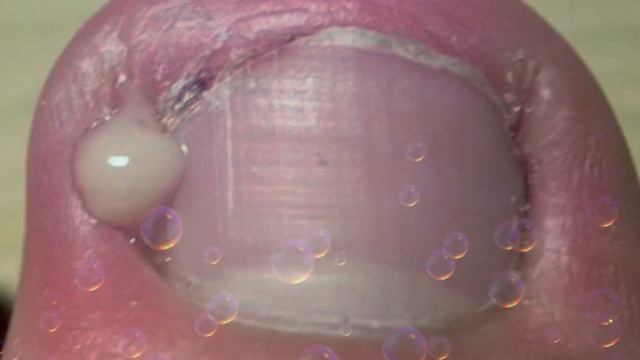 கால் நகத் தொற்று விடுபட சிறந்த வழிகள் | toenail fungal infection смотреть онлайн