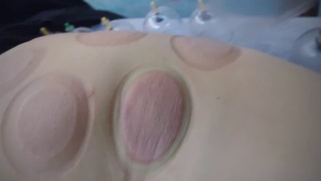 вакуумная коррекция области ягодиц смотреть онлайн