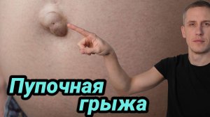 Как избавиться от пупочной грыжи без операции!