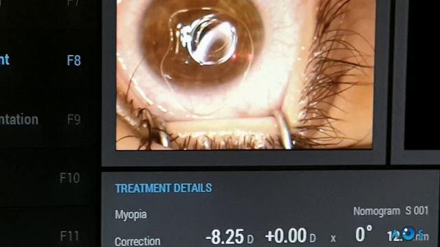 LASER Vision Correction: Femto LASIK and PRK eye surgery for high myopia (and astigmatism) смотреть онлайн