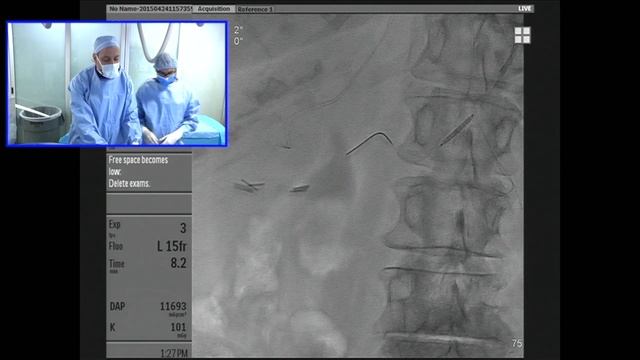 Transradial Approach to Renal Artery Angioplasty and Stenting смотреть онлайн